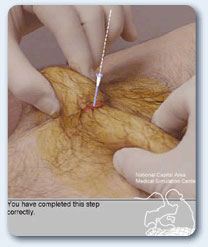 Insertion of the guidewire through cannula